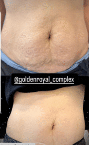 نمونه لاغری کلینیک زیبایی گلدن رویال