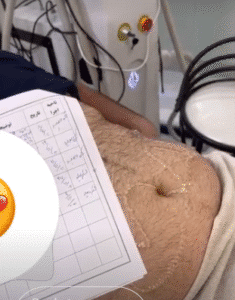 نمونه لاغری کلینیک زیبایی گلدن رویال