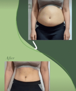 نمونه لاغری کلینیک زیبایی گلدن رویال