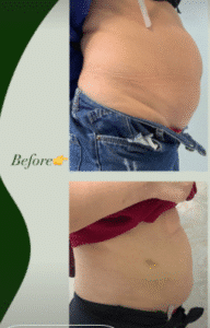 نمونه لاغری کلینیک زیبایی گلدن رویال