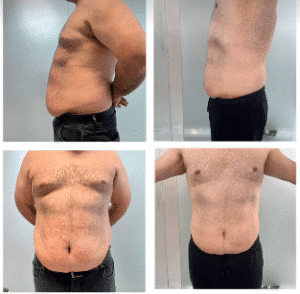 نمونه لاغری کلینیک زیبایی گلدن رویال