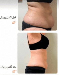 نمونه لاغری کلینیک زیبایی گلدن رویال