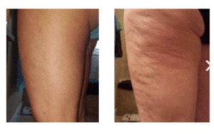 نمونه لاغری کلینیک لاغری مشهد اسلیم