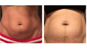 نمونه لاغری کلینیک لاغری مشهد اسلیم