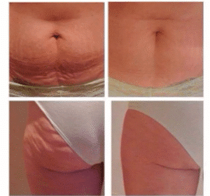 نمونه لاغری کلینیک لاغری مشهد اسلیم