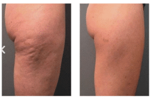 نمونه لاغری کلینیک لاغری مشهد اسلیم