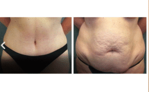 نمونه لاغری کلینیک لاغری مشهد اسلیم