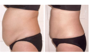 نمونه لاغری کلینیک لاغری مشهد اسلیم