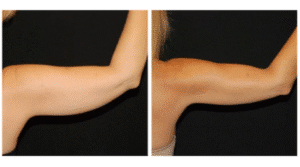 نمونه لاغری کلینیک لاغری مشهد اسلیم