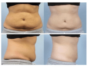 نمونه لاغری کلینیک لاغری مشهد اسلیم