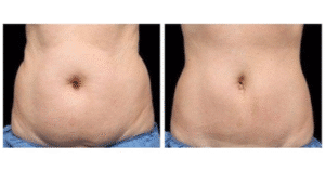 نمونه لاغری کلینیک لاغری مشهد اسلیم