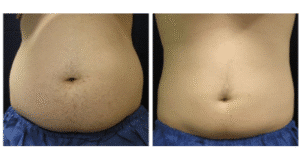 نمونه لاغری کلینیک لاغری مشهد اسلیم