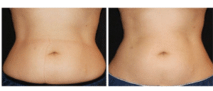 نمونه لاغری کلینیک لاغری مشهد اسلیم