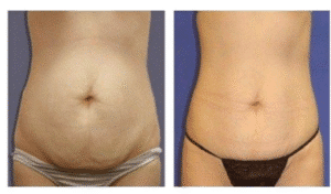 نمونه لاغری کلینیک لاغری مشهد اسلیم