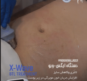 نمونه لاغری کلینیک نوآوران زیبایی