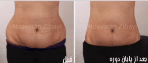 نمونه لاغری کلینیک نوآوران زیبایی