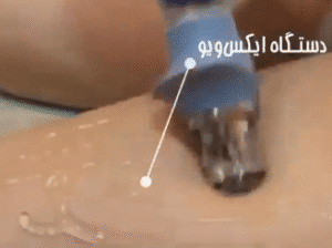 نمونه لاغری کلینیک نوآوران زیبایی