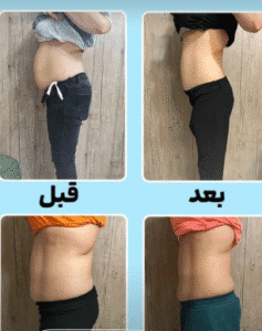 نمونه لاغری مرکز لاغری طراوت