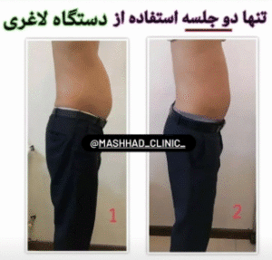 نمونه لاغری مرکز لاغری طراوت