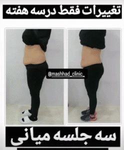 نمونه لاغری مرکز لاغری طراوت