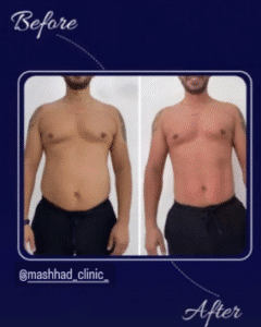 نمونه لاغری مرکز لاغری طراوت