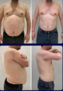 نمونه لاغری مرکز لاغری طراوت