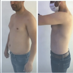 نمونه لاغری مرکز لاغری طراوت