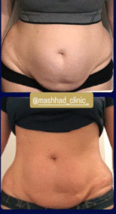 نمونه لاغری مرکز لاغری طراوت