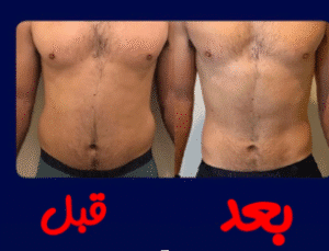 نمونه لاغری مرکز لاغری طراوت