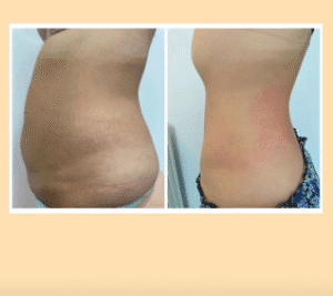 نمونه لاغری مرکز لاغری طراوت