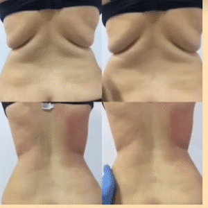 نمونه لاغری مرکز لاغری طراوت