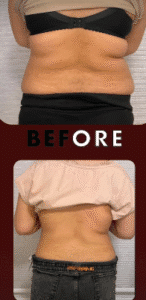 نمونه لاغری مرکز لاغری طراوت