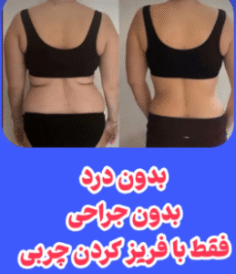 نمونه لاغری مرکز لاغری طراوت