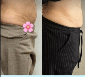 نمونه لاغری مرکز لاغری طراوت