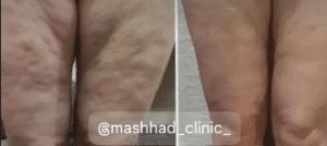 نمونه لاغری مرکز لاغری طراوت