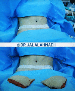نمونه جراحی لاغری دکتر جلال احمدی