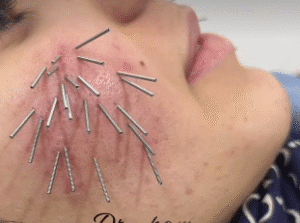 نمونه طب سوزنی دکتر لیلی حمیدنیا