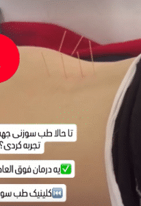 نمونه طب سوزنی دکتر لیلی حمیدنیا