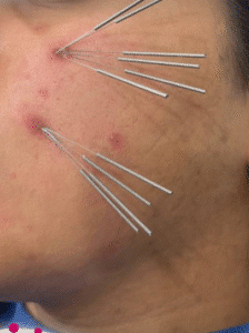 نمونه طب سوزنی دکتر لیلی حمیدنیا