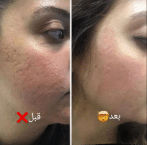 نمونه مزونیدلینگ کلینیک گلدن رویال