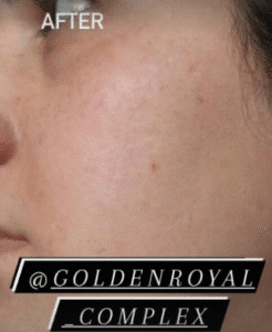 نمونه مزونیدلینگ کلینیک گلدن رویال