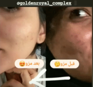 نمونه مزونیدلینگ کلینیک گلدن رویال