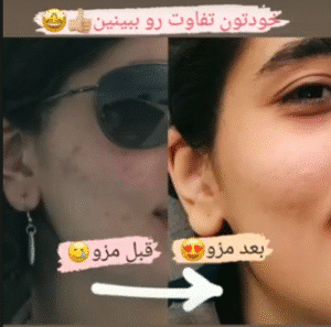 نمونه مزونیدلینگ کلینیک گلدن رویال