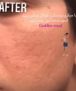 نمونه مزونیدلینگ کلینیک گلدن رویال