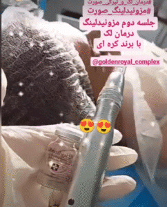 نمونه مزونیدلینگ کلینیک گلدن رویال