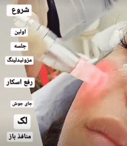 نمونه مزونیدلینگ کلینیک گلدن رویال