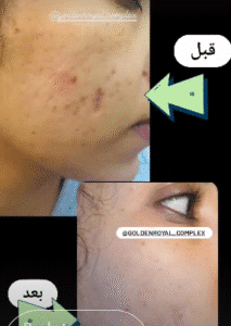 نمونه مزونیدلینگ کلینیک گلدن رویال