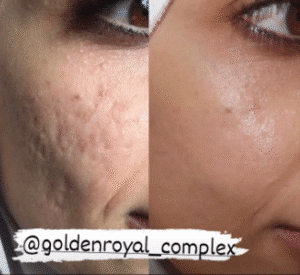 نمونه مزونیدلینگ کلینیک گلدن رویال