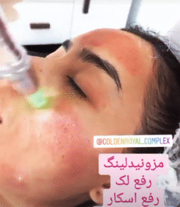 نمونه مزونیدلینگ کلینیک گلدن رویال