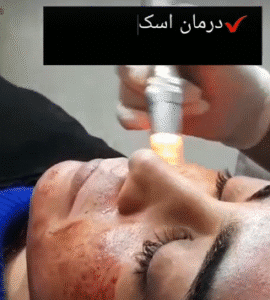 نمونه مزونیدلینگ کلینیک گلدن رویال